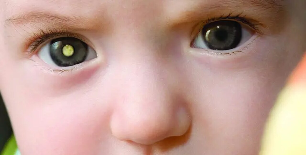 Campanha alerta para o retinoblastoma, câncer ocular que afeta crianças pequenas