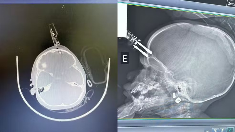 Bebê de um ano tem pino de carregador de celular cravado na cabeça após queda