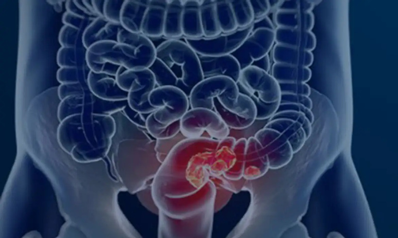 Especialistas alertam para diagnóstico precoce do câncer colorretal